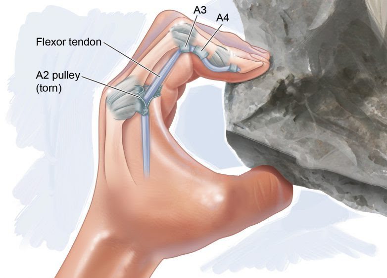 An illustration of the flexor tendons in the fingers.
By Steve Graepel, www.rockandice.com.