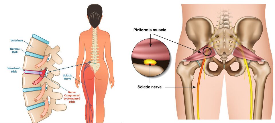 For Picture A: Herniated disc causing sciatica symptoms
For Picture B: Piriformis spasm leading to sciatic nerve irritation