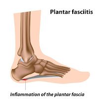 Plantar fasciitis inflammation